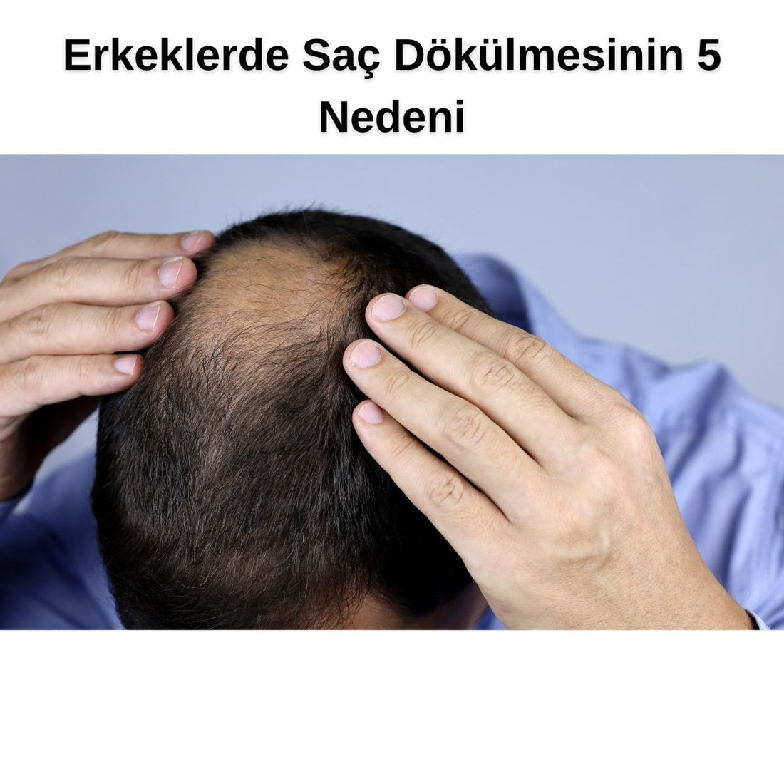 Erkeklerde Saç Dökülmesi: Nedenleri ve Çözüm Önerileri