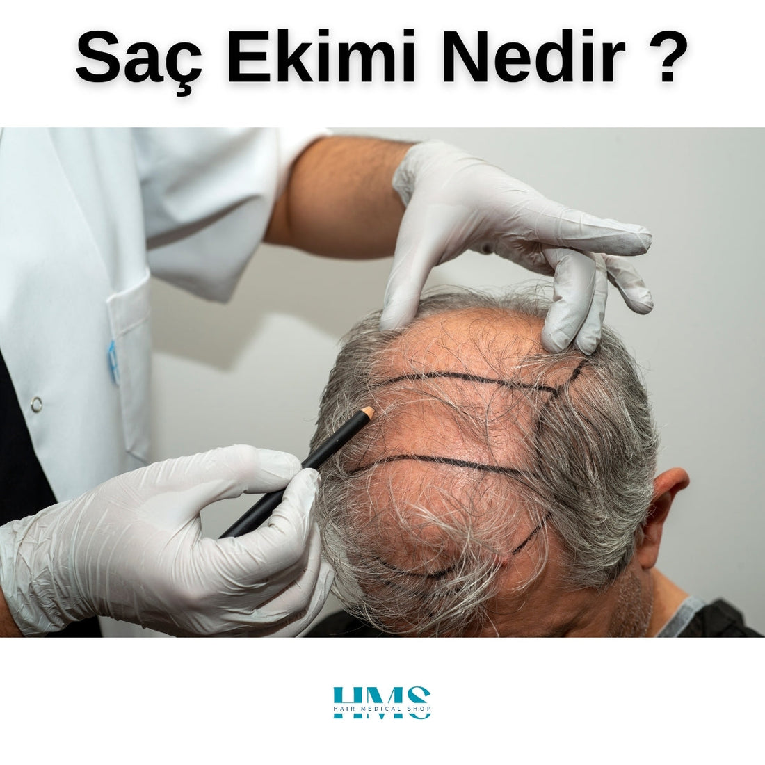 Saç Ekimi Nedir?